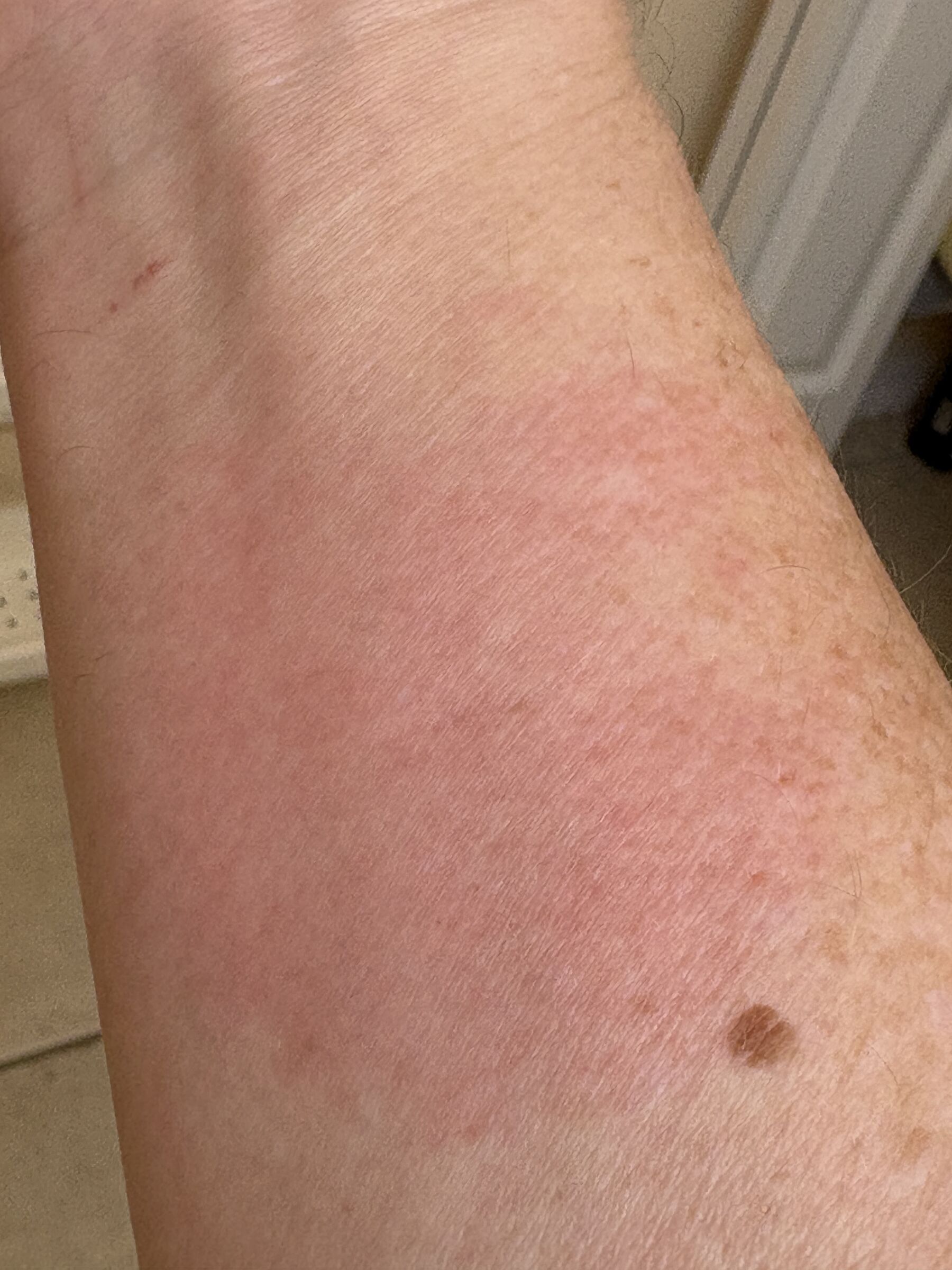 A forearm with a wide red welt from a wasp sting